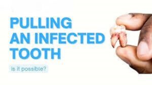 Can A Dentist Extract A Tooth That Is Infected