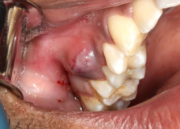 Infected Gums After Wisdom Teeth Removal