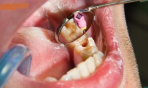 Infection After Root Canal