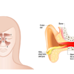Can Sinus Infection Cause Ear Pain