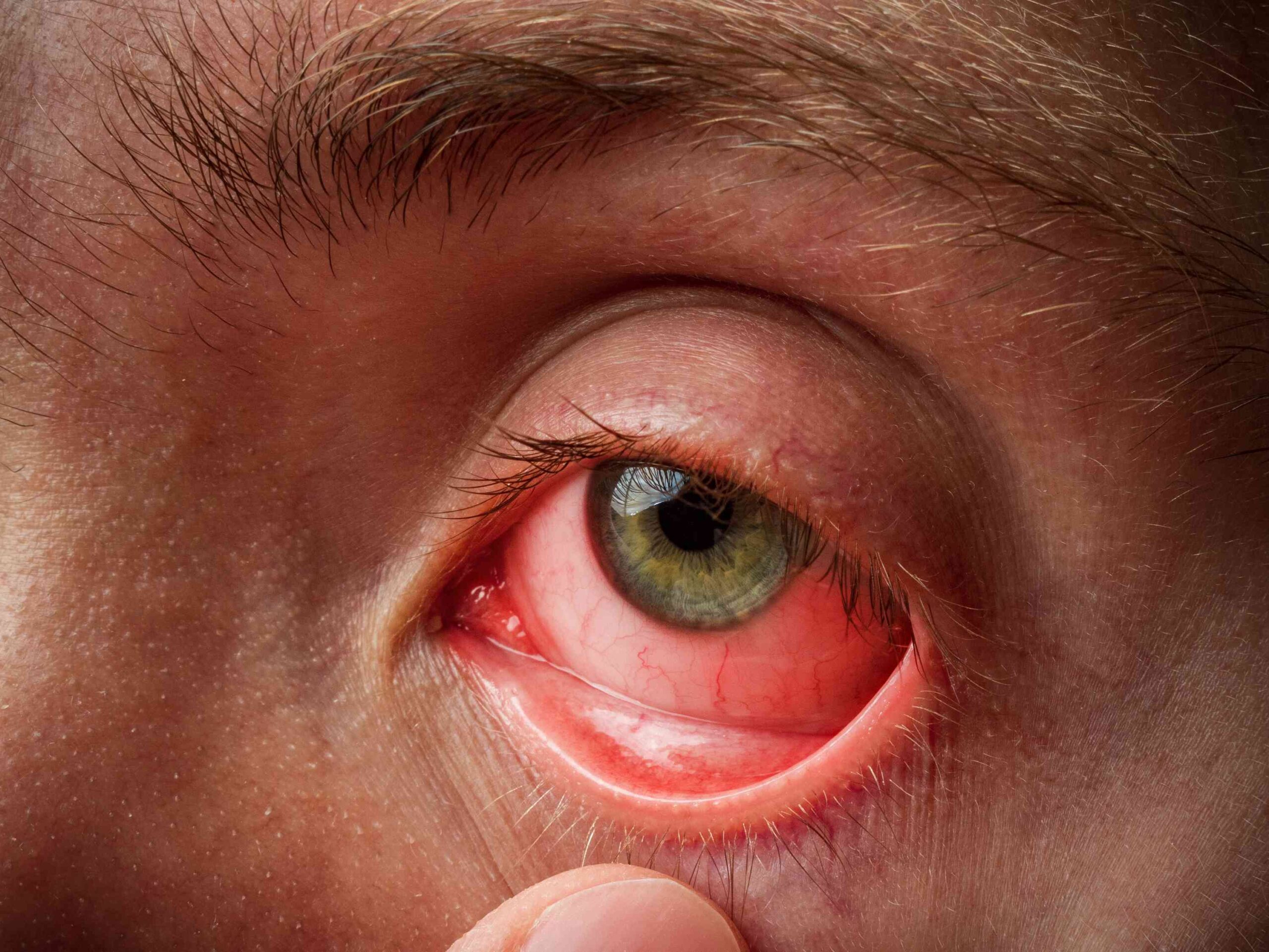 Sinus Infection Pink Eye