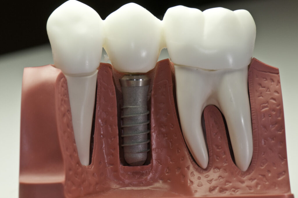 Dental Implant Infection