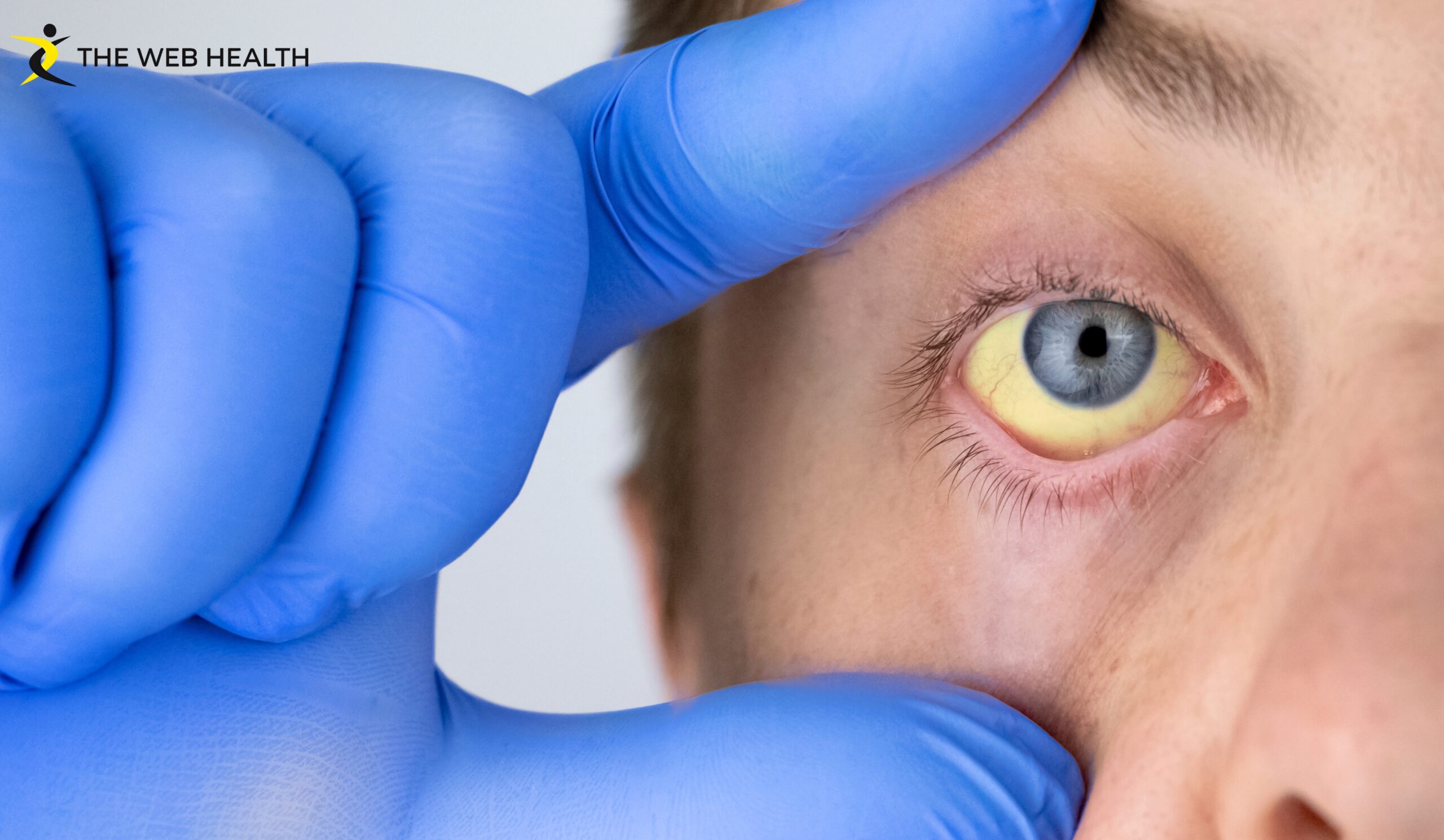 What Are the Signs and Causes of Low Iron Eyes