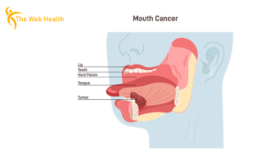 what is oral cancer​