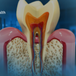 Kill Tooth Pain Nerve in 3 Seconds Permanently