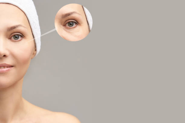 Dermal Fillers Under Eyes