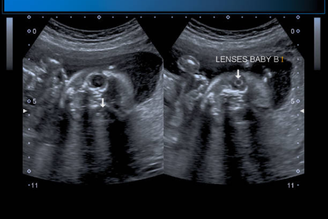 Diagnosing a Paraovarian Cyst