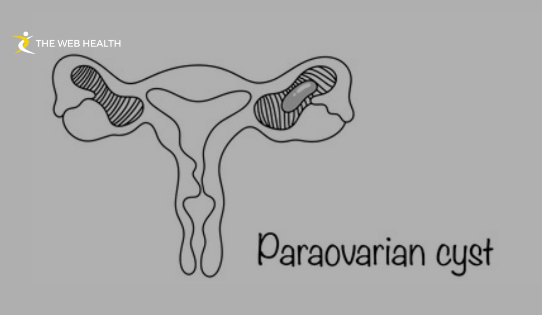 What Is a Paraovarian Cyst