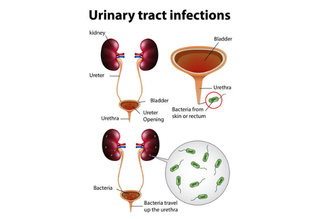 What Is a UTI & what causes UTI