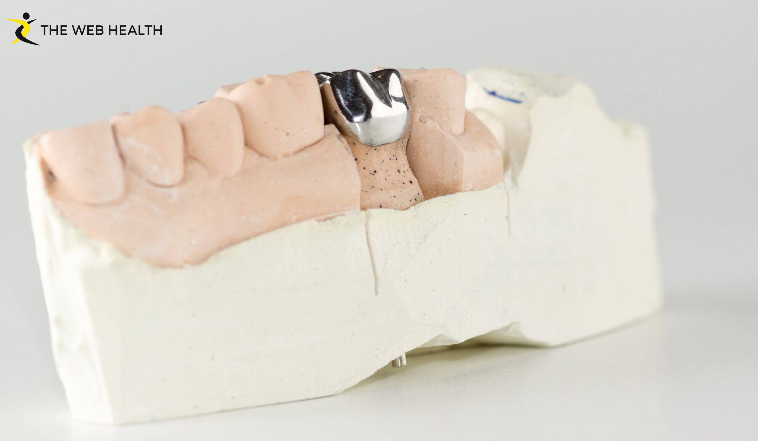 Temporary Crown: What It Is, How Long It Lasts & Proper Care