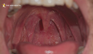 why does the roof of my mouth hurt