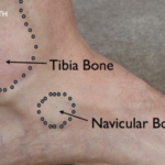 Navicular Bone Pain Causes, Symptoms, and Treatment Guide