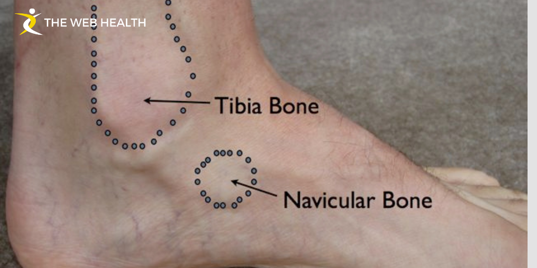 Navicular Bone Pain Causes, Symptoms, and Treatment Guide