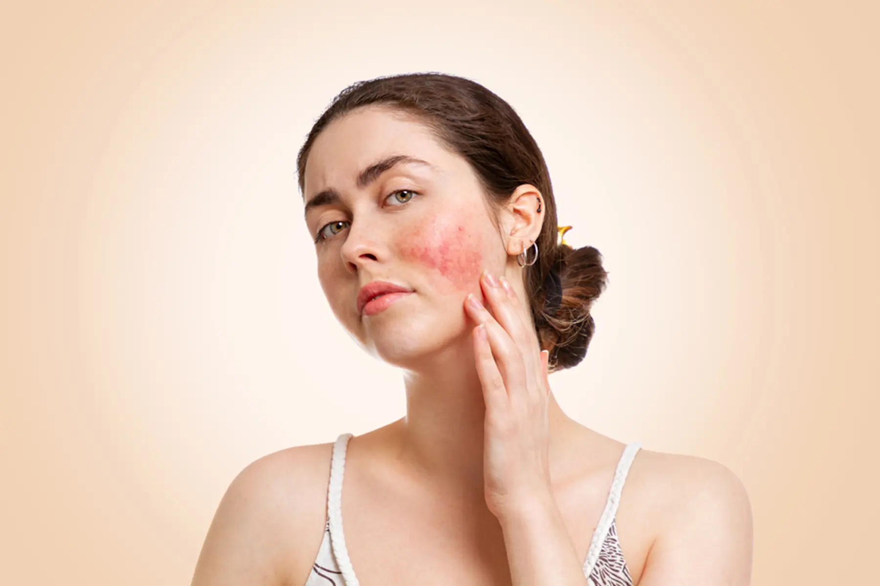 Can amoxicillin cause a skin rashes