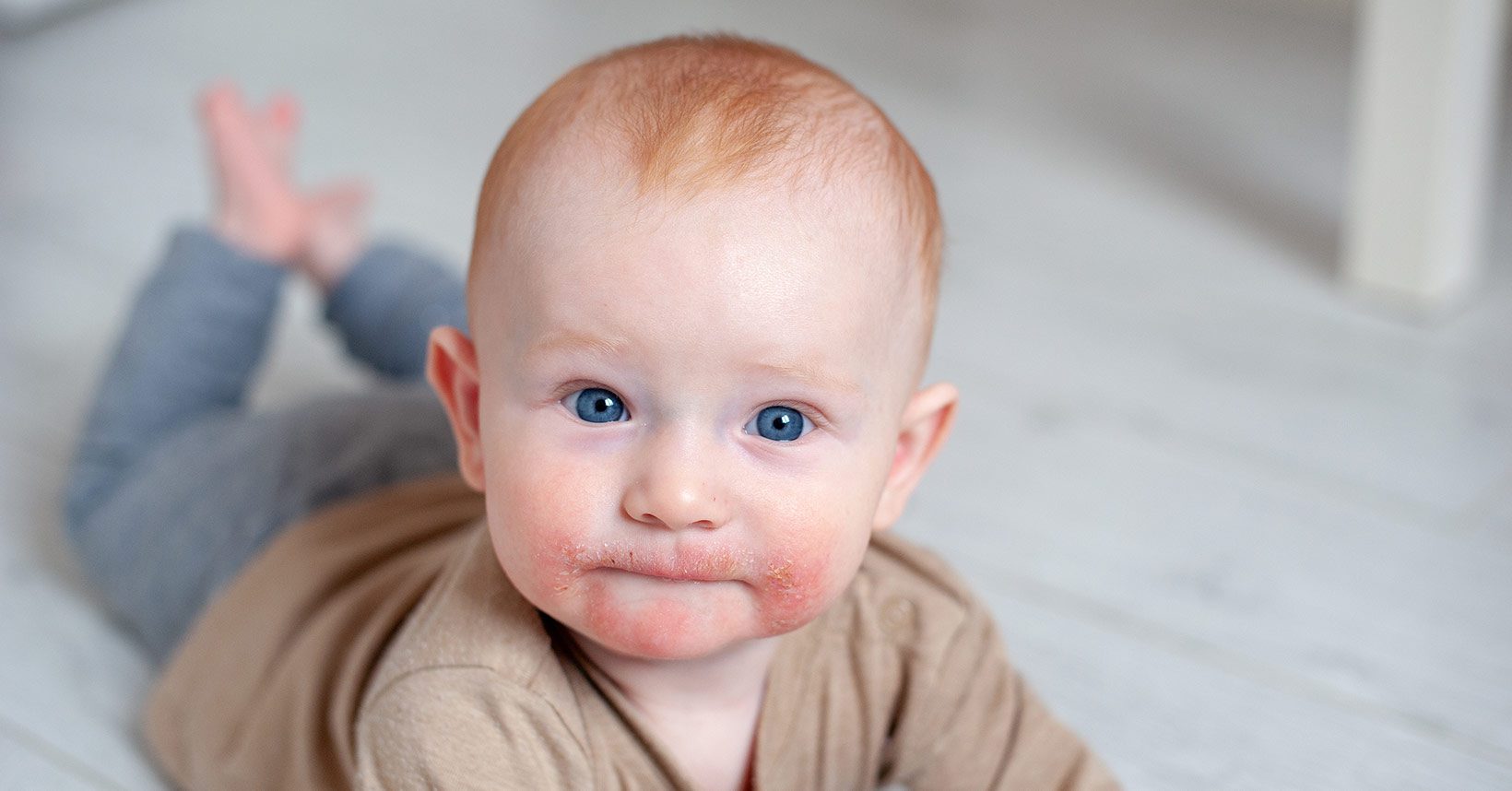 Teething Rash Causes & Treatment You Need to Know