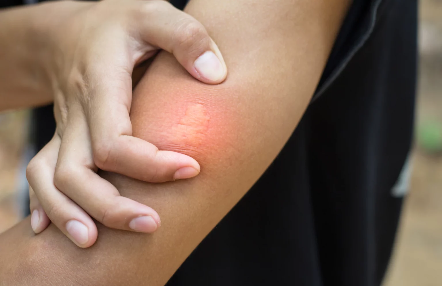 Wasp Sting Symptoms Treatment and When to Seek Medical Help