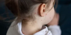Measles: Causes, Symptoms, Prevention, and Treatment