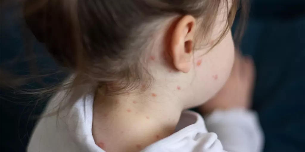 Measles: Causes, Symptoms, Prevention, and Treatment